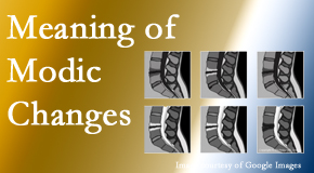 Poulin Chiropractic of Herndon and Ashburn sees many back pain and neck pain patients who bring their MRIs with them to the office. Modic changes are often noted. 