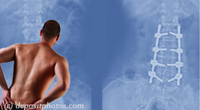 Ashburn chiropractic respite for back pain after back surgery