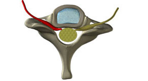 Cervical-Herniated-290-160.jpg