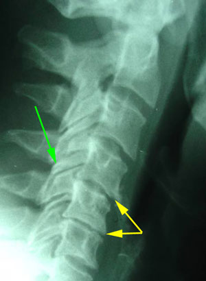 disc degeneration treated at Poulin Chiropractic of Herndon and Ashburn
