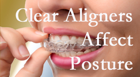 Clear aligners influence posture which Ashburn and Herndon chiropractic helps.