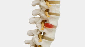 Ashburn chiropractic conservative care helps even giant disc herniations go away