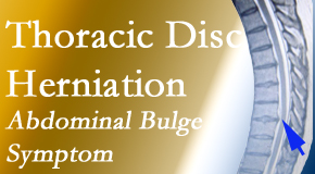 Poulin Chiropractic of Herndon and Ashburn cares for thoracic disc herniation that for some patients prompts abdominal pain.