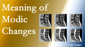 Poulin Chiropractic of Herndon and Ashburn sees many back pain and neck pain patients who bring their MRIs with them to the office. Modic changes are often noted.