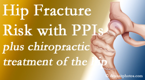 Poulin Chiropractic of Herndon and Ashburn shares new research describing higher risk of hip fracture with proton pump inhibitor use.