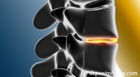 Ashburn degenerative spinal changes 