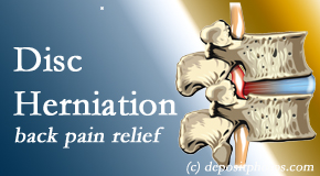 Poulin Chiropractic of Herndon and Ashburn uses non-surgical treatment for relief of disc herniation related back pain. 