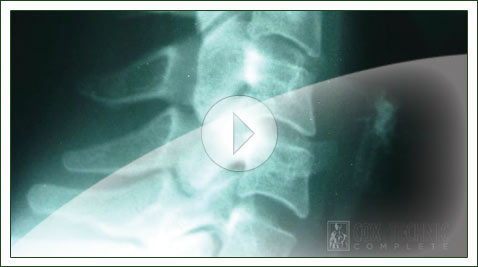 minimal retrolisthesis of c5 on c6 minimal retrolisthesis of c5 on c6