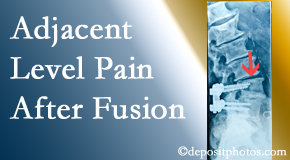 Poulin Chiropractic of Herndon and Ashburn offers relieving care non-surgically to back pain patients suffering with adjacent level pain after spinal fusion surgery.