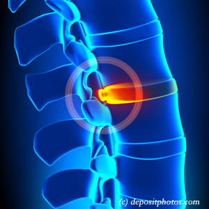 image of lumbar Ashburn disc herniation