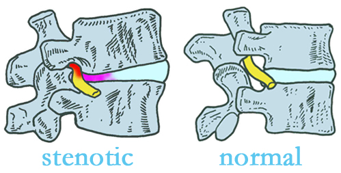 Ashburn and Herndon stenotic and normal spinal discs